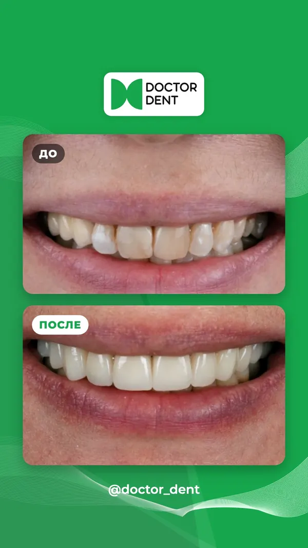 Ещё один дизайн сторис до и после Doctor Dent
