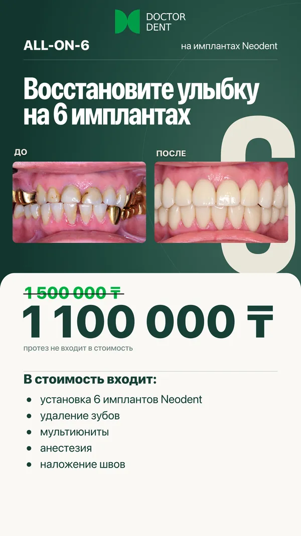 Сторис Doctor Dent All-on-6 с ценой
